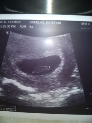 Desprendimiento de placenta | BabyCenter