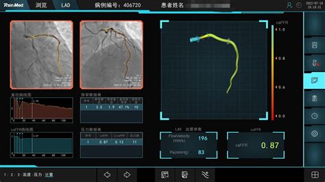 迈入“心”时代丨caFFR技术，为冠脉介入手术精准“导航” - 心血管内二科 - 湘南学院附属医院