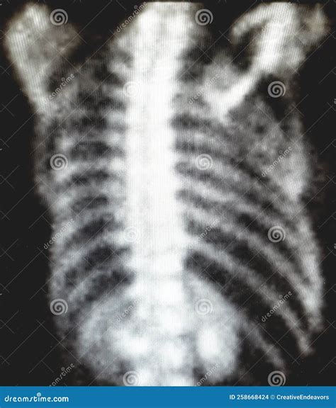 Image result for Normal Bone Scan