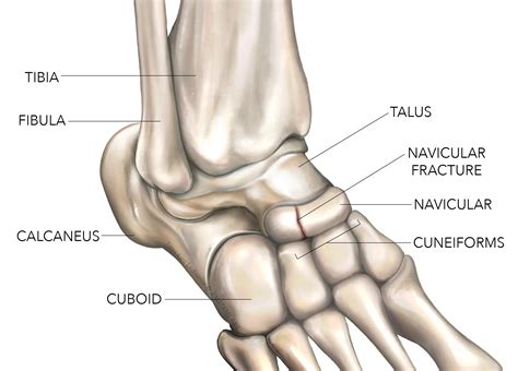 Navicular Fracture - Symptoms, Causes, and Treatment
