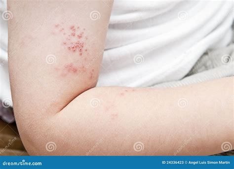 Herpes in a child arm. stock image. Image of pathology - 24336423