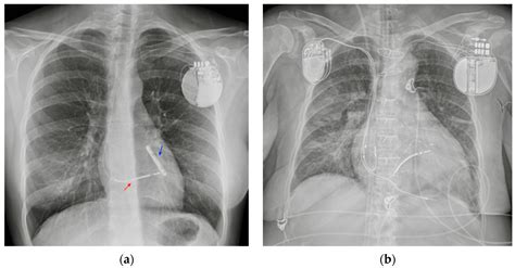 Chest X-ray Interpretation: Detecting Devices and Device-Related Complications