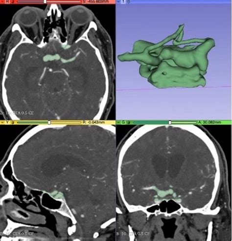Image result for 3D Slicer Segmentation Tutorial