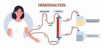 Image result for dialyzes