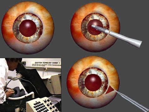 Image result for Eye Surgery Simulation