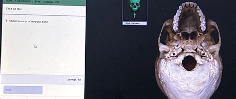 Image result for Temporal Styloid Process Anatomy