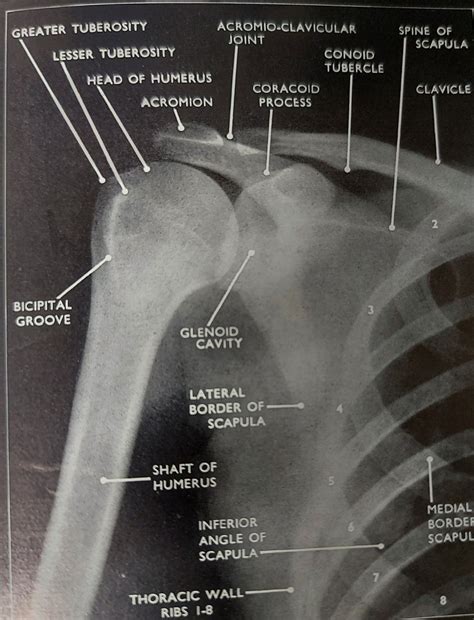 AP shoulder anatomy (X-ray) | Medical radiography, Radiology student ...