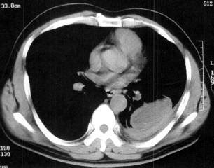 结核性胸膜炎的CT报告书写技巧与提示 – 影像PPT