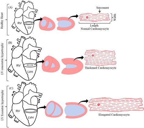 Role of metabolomics in identifying cardiac hypertrophy: an overview of ...