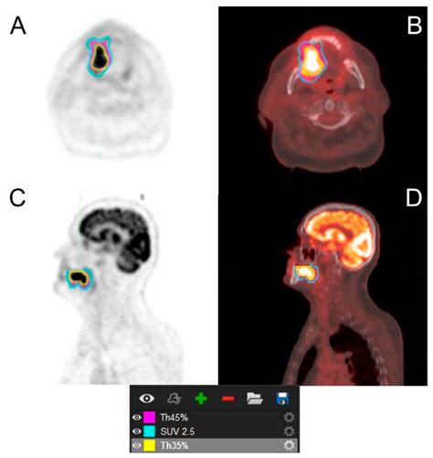 Influence of Semiquantitative [18F]FDG PET and Hematological Parameters ...