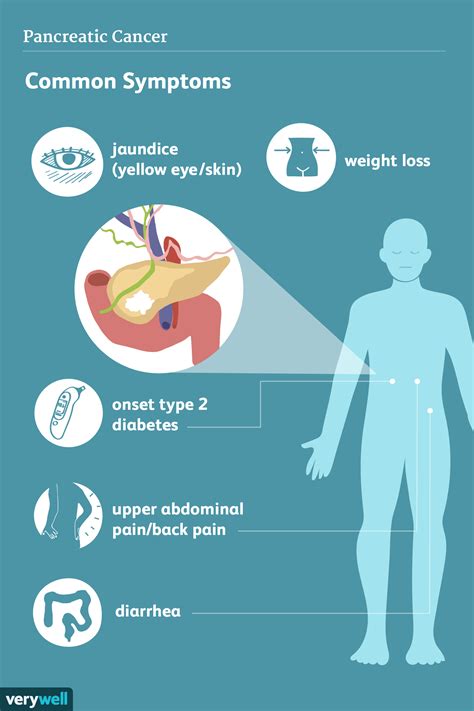Pancreatic Cancer: Signs, Symptoms, and Complications