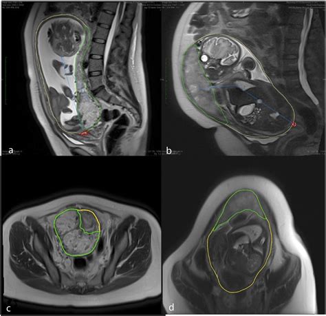 Magnetic Resonance Imaging-Based Radiomics of Axial and Sagittal ...