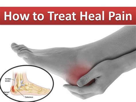 How to Treat Heel Pain Easily | Cure Heel Pain - YouTube