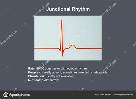 Junctional Rhythm Inverted P Wave
