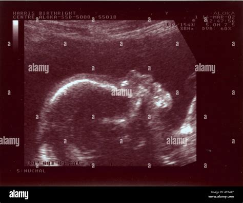 20 Week Fetus Ultrasound