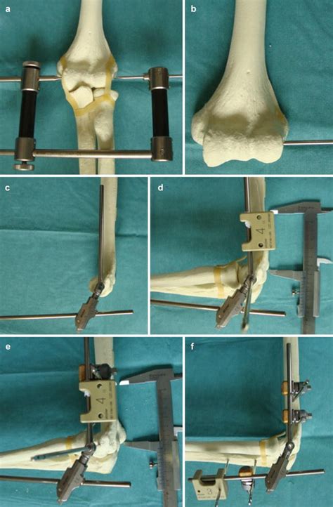 Image result for External Fixation Explained