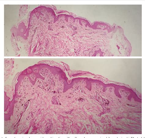Fixed pigmented erythema | Semantic Scholar