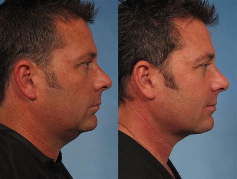Male Face/Neck Lift Before and After Photo Gallery | Naples, FL | Kent V. Hasen, MD: Aesthetic ...