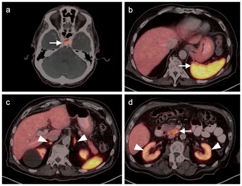 Image result for DOTA-TATE Scan