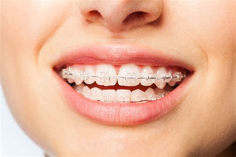 Image result for braces