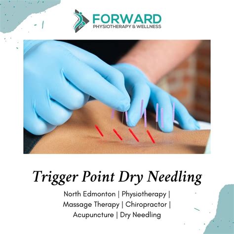 Trigger Point Dry Needling | Dry needling, Physiotherapy, Trigger points