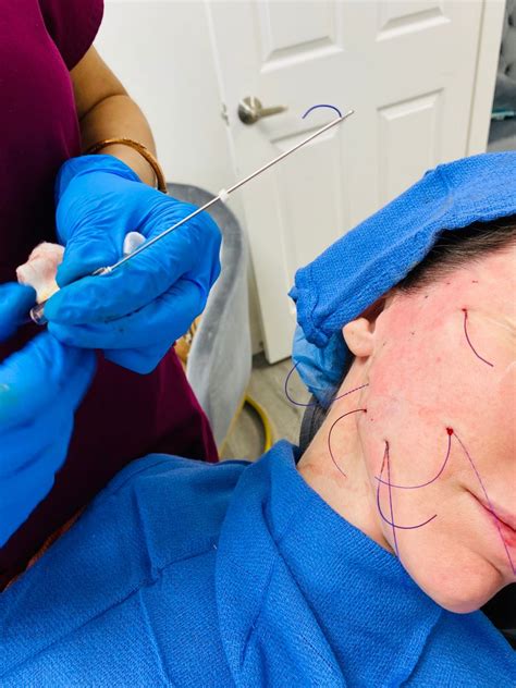 Image result for Thread Brow Lift Procedure