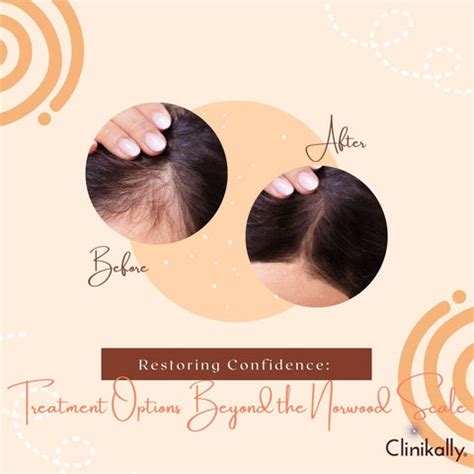 Decoding the Norwood Scale: Understanding Hair Loss Patterns | Clinikally