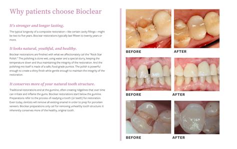 Image result for Bioclear Matrix System