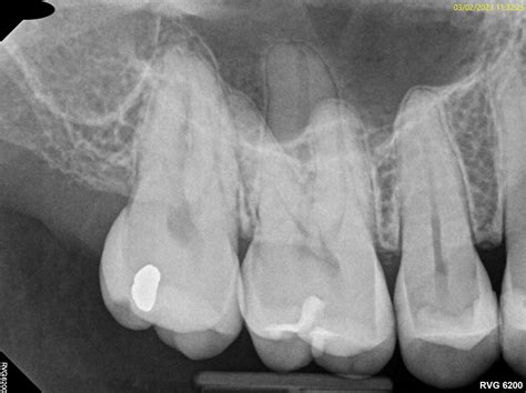 Scheduled for rct for very mild pain (1 on scale of 10) in tooth #4. Pain has completely ...
