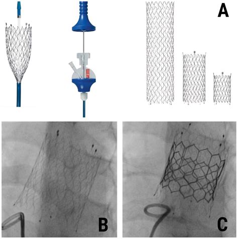 Stents autoexpandibles SINUS XL para implante previo en el recambio valvular pulmonar - Revista ...