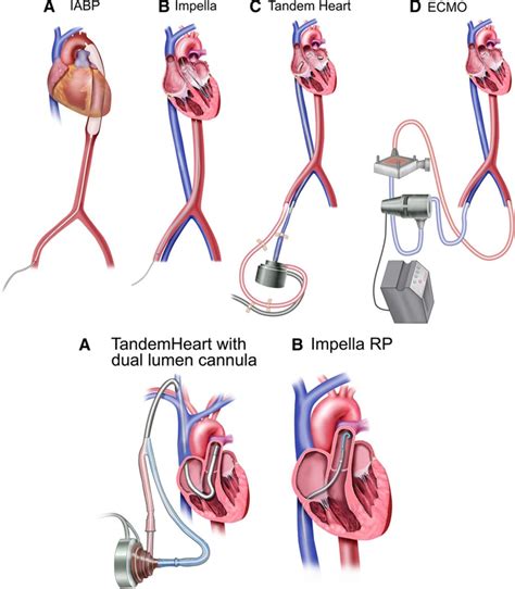 Percutaneous Mechanical Circulatory Support Devices in Cardiogenic ...