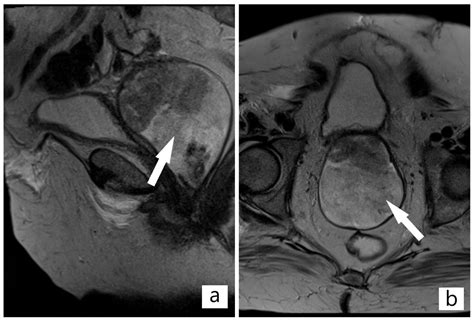 Atypical Polypoid Adenomyoma of the Vagina: Follow Up and Subsequent ...
