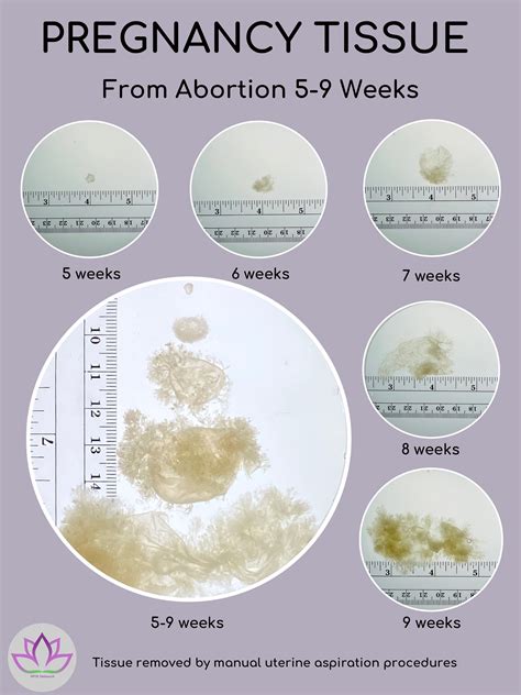 Medical Abortion 5 Weeks
