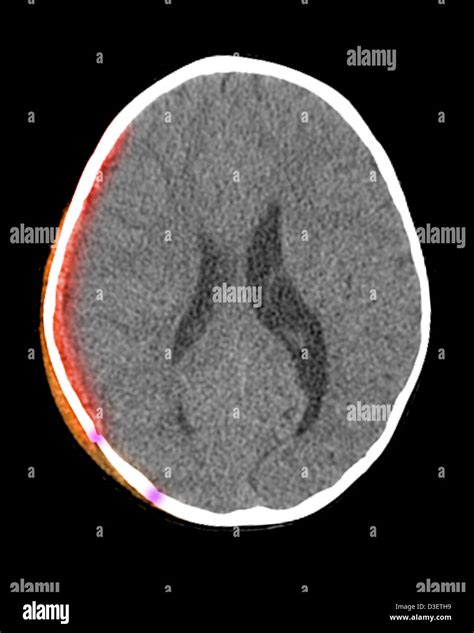 Subdural High Resolution Stock Photography and Images - Alamy