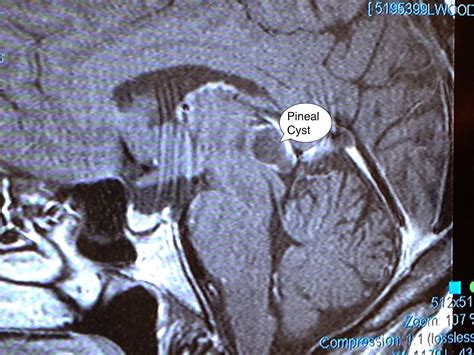 Gray Matters To Me - Symptomatic Pineal Gland Cysts Do Exist!: May 2015