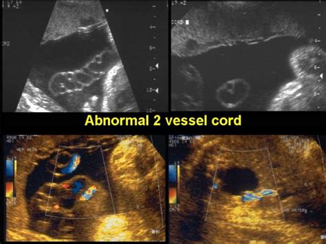Bildergebnis für 2 vessel umbilical cord ultrasound