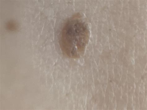 Seborrheic keratosis or possible melanoma? : r/Melanoma