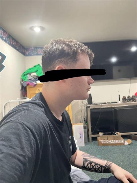 short face syndrome? I have invisalign for my overbite but i’m scared that my face doesn’t look ...