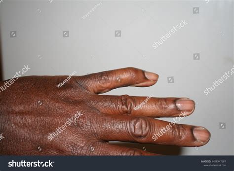 Dislocated Pinky Finger