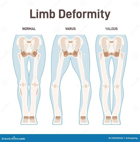 Limb Anatomy Scheme. Valgus and Varus Leg Deformities Stock Vector - Illustration of genu, ankle ...