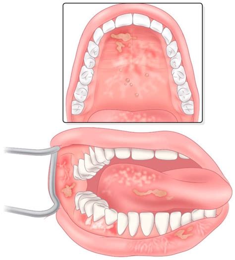 Oral Chronic Graft-Versus-Host Disease: Pathogenesis, Diagnosis ...