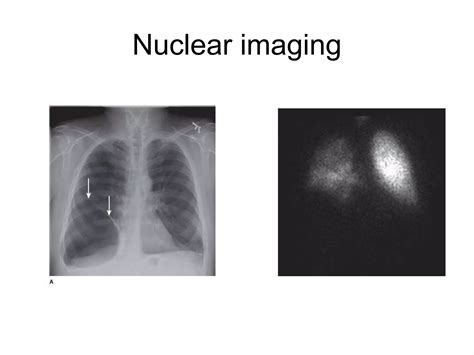 Approach to Bullous lung disease | PPT