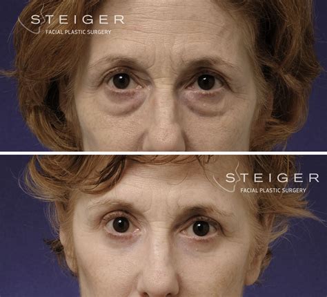 Blepharoplasty Eyelid Surgery Photos Before and After