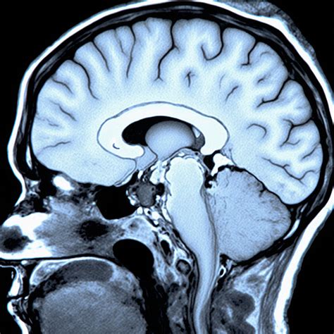 MRI Scan with GSS Disease Labels | Stable Diffusion Online