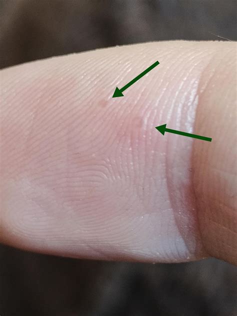 I have these bumps on my fingers that form every so often, but I have never had them when I'm ...