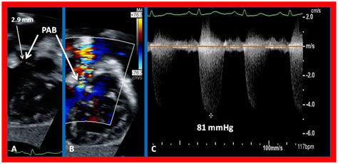 Double-Inlet Left Ventricle