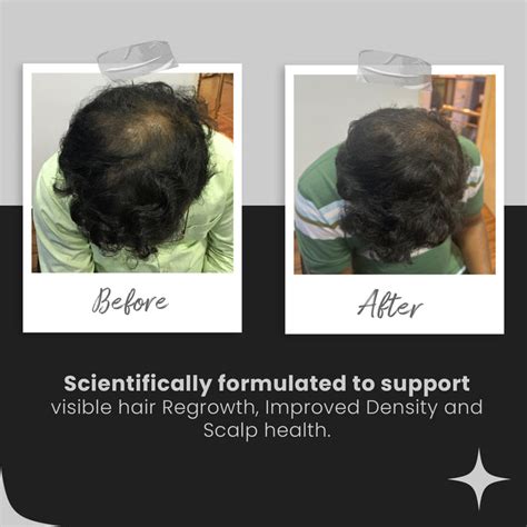 Skin Vitals Exosomes Hair Serum