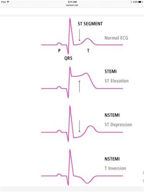 NSTEMI | Nursing school survival, Pharmacology nursing, Medical school essentials