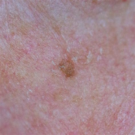 Inflamed Seborrheic Keratosis