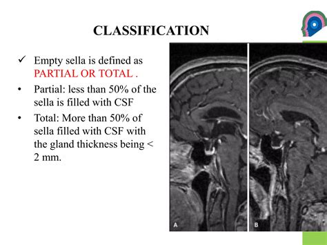 Empty sella syndrome | PPTX